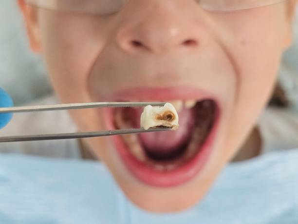 Best Dental Abscess Treatment in Girardville, PA